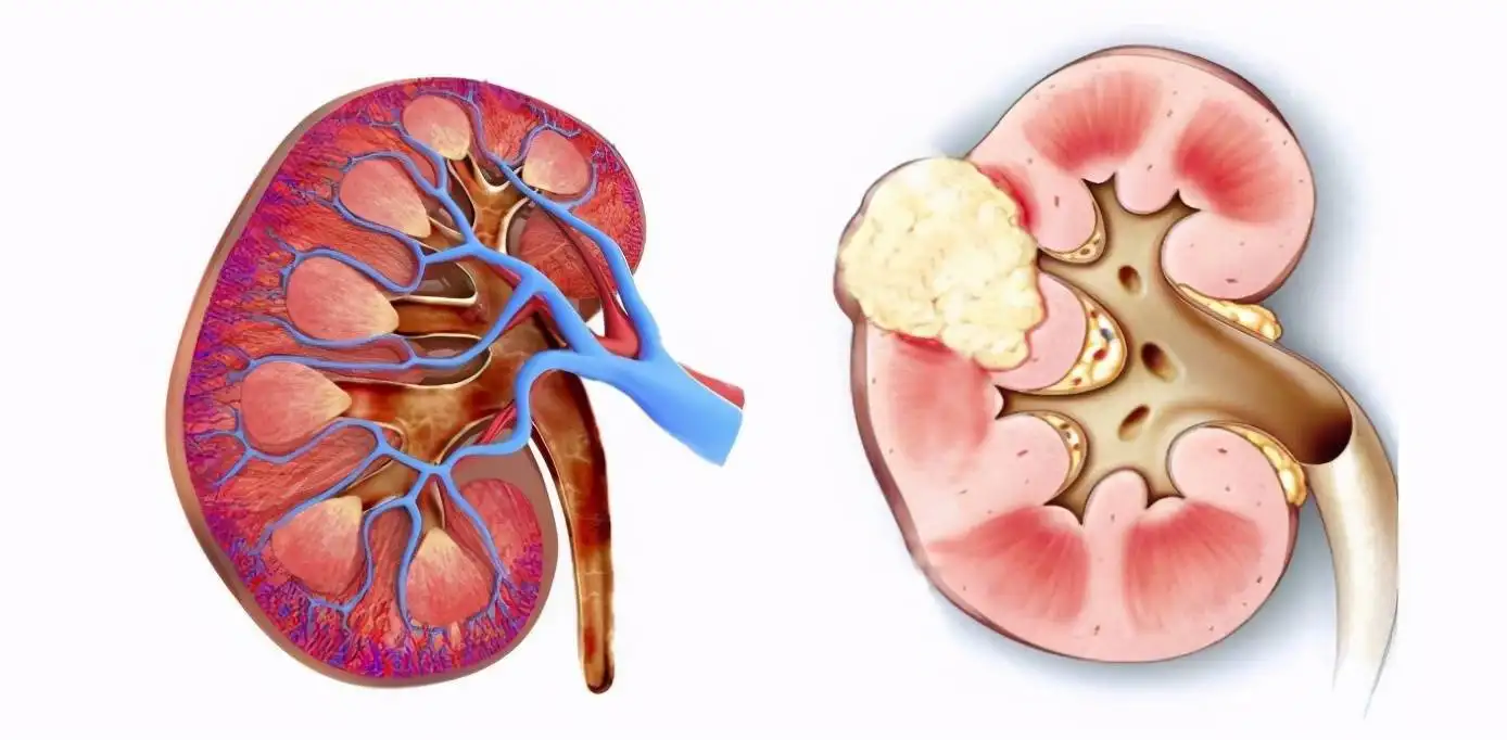 晚期肾细胞癌（RCC）：替沃扎尼（tivozanib）与阿昔替尼（axitinib）患者如何选择