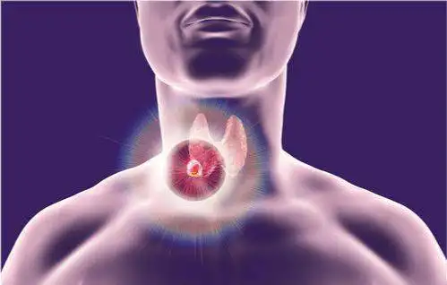 普拉替尼(Pralsetinib)Gavreto治疗甲状腺癌疗效如何？在哪里买比较靠谱？