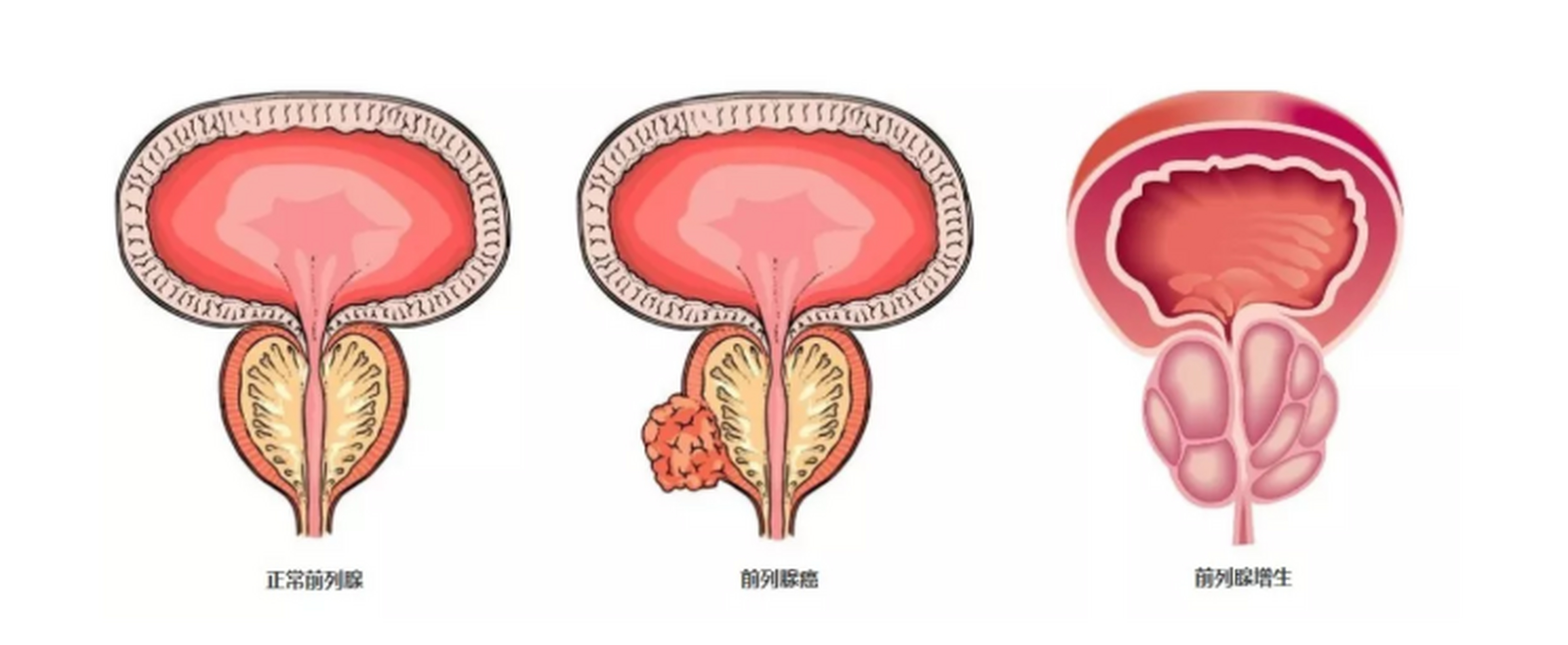 奥拉帕利（olaparib）治疗前列腺癌疗效如何？