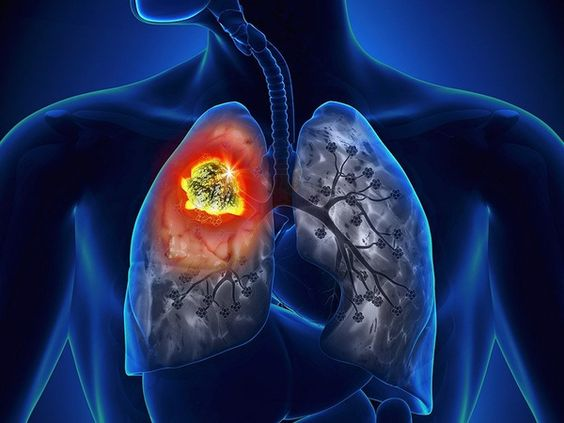 长期数据支持：卡马替尼在 METex14 NSCLC 中的使用