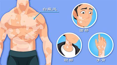 国内如何获取？芦可替尼乳膏解锁白癜风治疗新途径