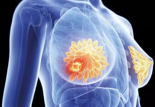 探秘 2025：最新乳腺癌药物的疗效与国内可及性