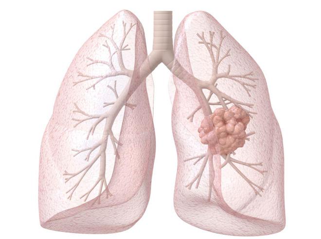 莫博塞替尼：为EGFR ex20ins突变NSCLC患者破局